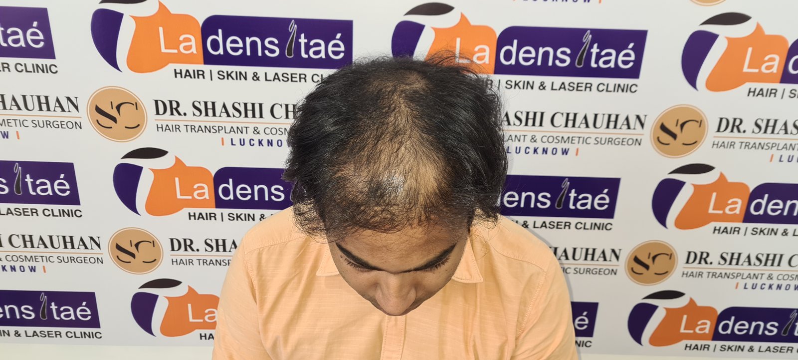 Arnav Dayal Before Hair Transplant